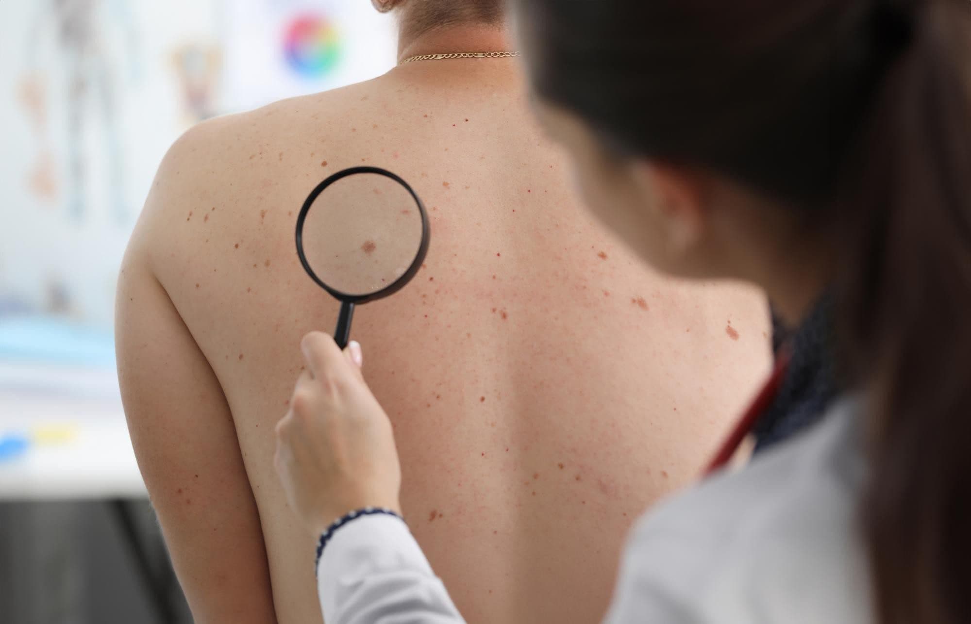 Cáncer de piel